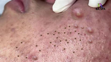 sloppy black head|Blackheads, Blackhead Popping & Black Heads! .